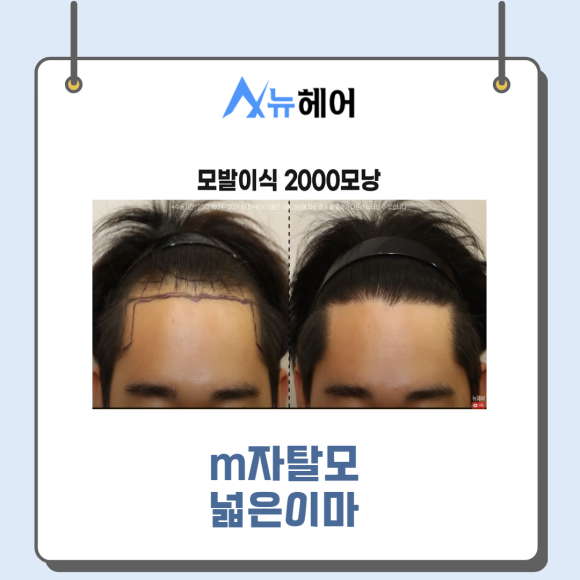 강남모발이식 m자교정 빈틈없이 빽빽하게 관련 이미지 3