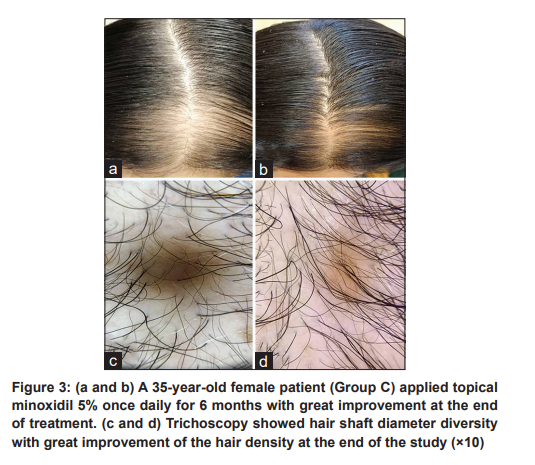 Comparing the Effects of Oral Finasteride and Topical Minoxidil in Female Hair Loss image 5