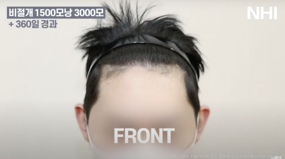 비절개 모발이식 후기 1년 사진 l 암흑기 지나고 후기 관련 이미지 2