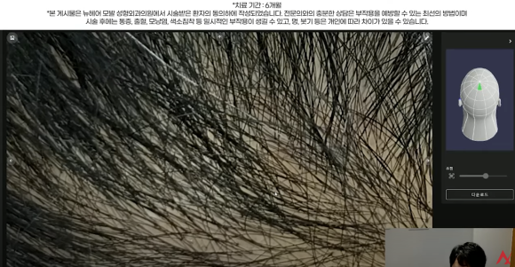 남성 정수리 탈모 치료 수술없이 주사만으로?(탈모약+주사치료) 관련 이미지 7