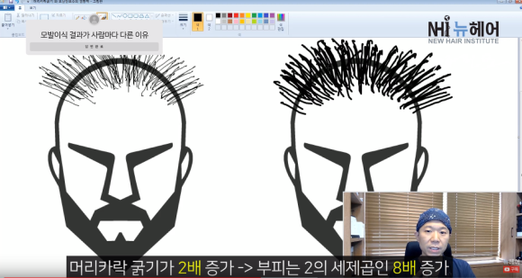 모발이식 결과가 사람마다 다른 이유  ㅣ모발이식 결과  l 모발이식 실패 관련 이미지 2