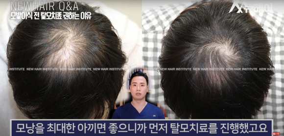 모발이식 알아봐야 한다면 관련 이미지 7