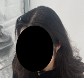 SMP후기, 두피문신 받고 자신감 회복한 30대 여성분 사례 관련 이미지 9