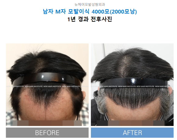 모발이식이 꼭 필요한 사람 VS 필요 없는 사람, 탈모 유형별 확인법 관련 이미지 2