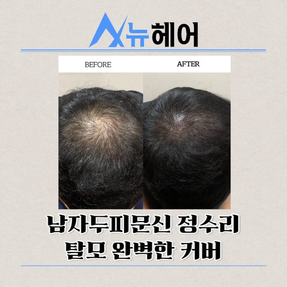 남자두피문신 정수리탈모 완벽한 커버 관련 이미지 1