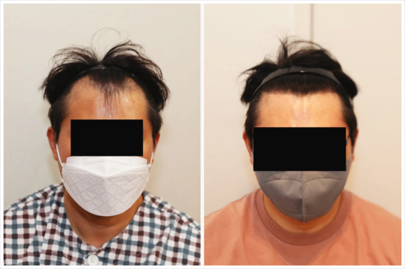 M자 모발이식 후기? 3가지를 함께 확인하세요 관련 이미지 1