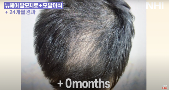 정수리 탈모 치료 l 탈모치료 후기ㅣ모낭주사 효과 1년 후 관련 이미지 2
