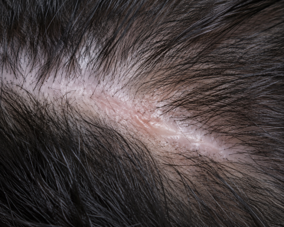 Does Hair Transplantation Graft Survival Vary by Skin Type? (Oily, Dry, and Thin Scalp) image 5
