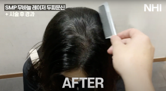 가르마 두피문신 후기 전후사진 l 여성 탈모치료 두피문신 관련 이미지 3
