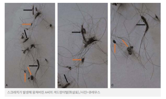 달리면 빠지는 건 머리카락이 아니라 겨드랑이 털입니다(겨드랑이 탈모) 관련 이미지 2