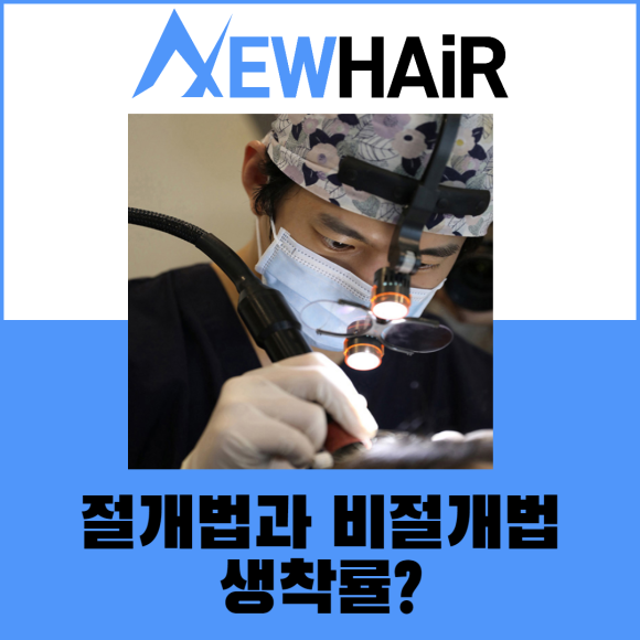 모발이식 수술 생착률 차이점은? 관련 이미지 3