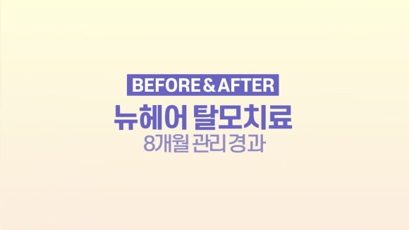뉴헤어 탈모치료(모낭주사) 8개월 경과 사진 l 정수리탈모 관련 이미지 1