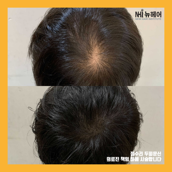 [정수리 탈모] 두피문신 전후사진 모음 관련 이미지 3