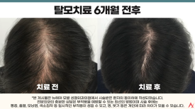 탈모주사치료 후 중단해도 될까? 효과는 유지될까? 관련 이미지 4