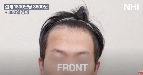 [뉴헤어] 모발이식 1800모낭(3600모) 1년 경과 사진 관련 이미지 2
