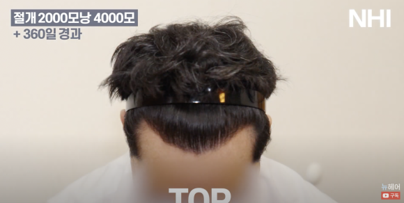 [뉴헤어] 남자 모발이식 2000모낭(4000모) 전후 비교 l 엠자이마 l 탈모 관련 이미지 7