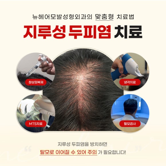 지루성 두피염 치료, 두피 환경을 바꾸는 관리법은? 관련 이미지 2