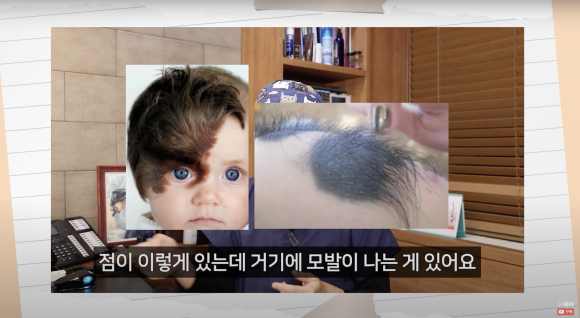 점에 난 털(털모반)을 이용한 탈모치료? 관련 이미지 1