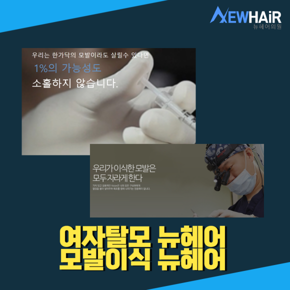 여자 탈모치료 모발이식 여름에는 안한다? 관련 이미지 5