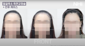 이마축소! 얼굴 작아지는 헤어라인교정 l 여자 모발이식 전후 사진 보기 관련 이미지 5