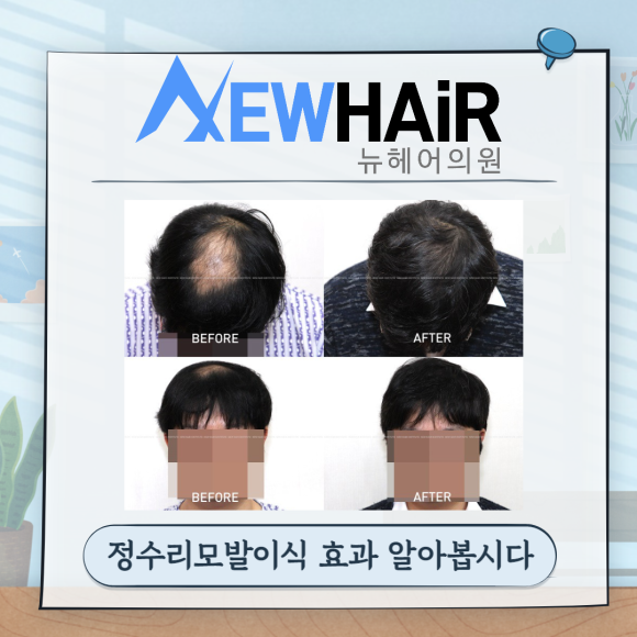정수리모발이식 효과 알아봅시다 관련 이미지 1