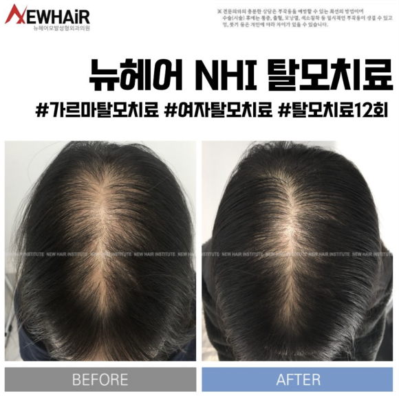 정수리 탈모고민 이것부터 하세요 관련 이미지 5