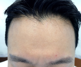 비수술탈모관리, 어떤 과정을 거치게 될까? 관련 이미지 2