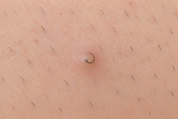 Ingrown Hair (Hair Growing Into the Skin): Inflammation and Care Methods image 2