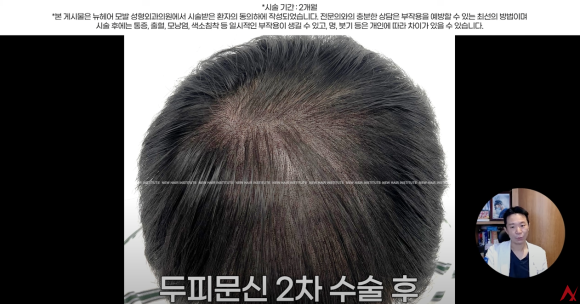 정수리탈모문신 시술직후 나타나는 효과?(전후사진) 관련 이미지 10
