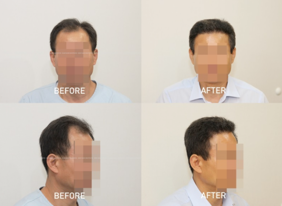 모발이식 최적화 배치, 같은 수술을 받아도 결과가 다른 이유 관련 이미지 1
