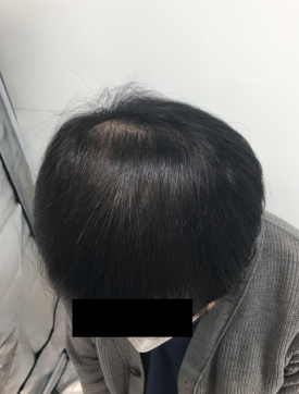 탈모치료주사? 효과 있을까 궁금하신 분들만 보세요 관련 이미지 9