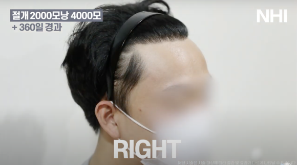 뉴헤어 남자 모발이식 후기(2000모낭) 모발이식 1년 효과 후기 관련 이미지 4
