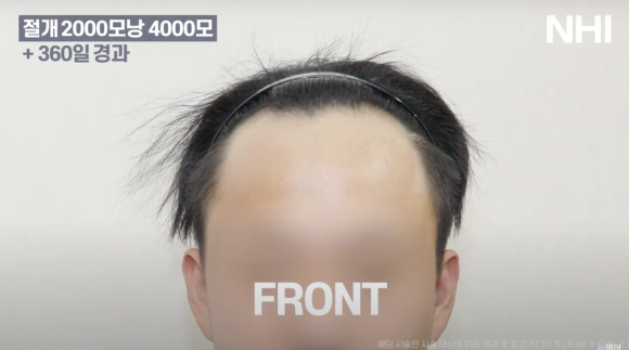 뉴헤어 남자 모발이식 후기(2000모낭) 모발이식 1년 효과 후기 관련 이미지 1