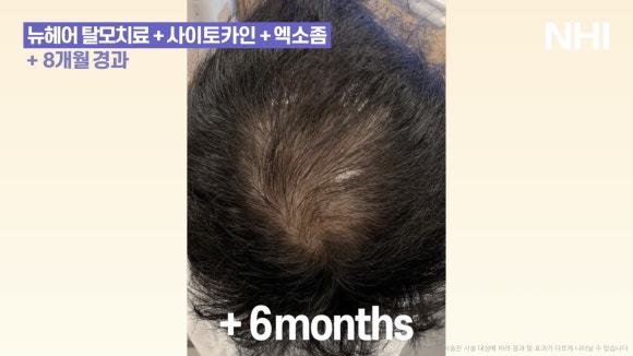 뉴헤어 탈모치료(모낭주사) 8개월 경과 사진 l 정수리탈모 관련 이미지 4