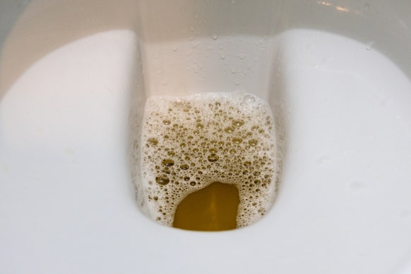 A Lot of Foam in My Urine: Proteinuria Symptoms (Pregnancy, Diabetes, Causes) image 1