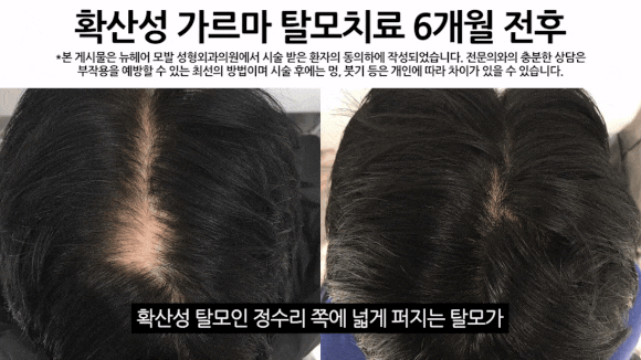 탈모치료방법, 비수술로 해결될까요? 관련 이미지 3