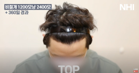 비절개 모발이식 헤어라인 엠자채우기 l 남자 탈모 모발이식 2400모 전후 사진 후기 관련 이미지 6