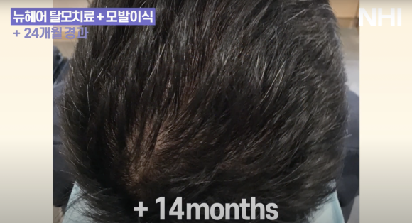 정수리 탈모 치료 l 탈모치료 후기ㅣ모낭주사 효과 1년 후 관련 이미지 4