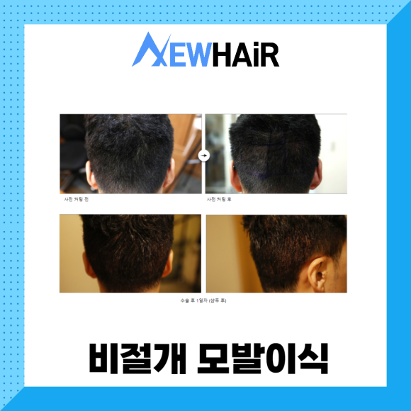비절개모발이식 고민한다면 관련 이미지 5