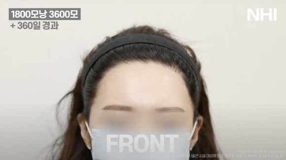 헤어라인교정 #여자모발이식 1800모낭 1년 후기 사진 관련 이미지 2