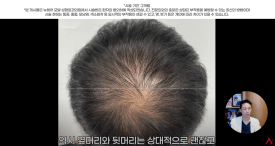 정수리탈모문신 시술직후 나타나는 효과?(전후사진) 관련 이미지 17