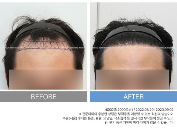 하루에 담배 00개비 피우면 탈모로 대머리 된다? 관련 이미지 6