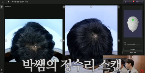 탈모약 중단, 끊으면 한 번에 머리카락 다 빠질까? 관련 이미지 6