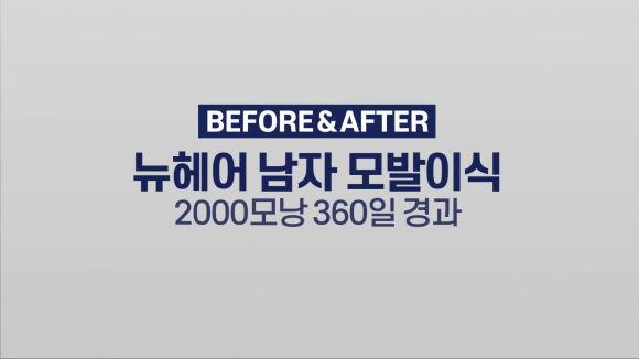 M자탈모(엠자탈모) 모발이식 1년 후 모습 공개 l 2000모낭(4000모) 관련 이미지 1