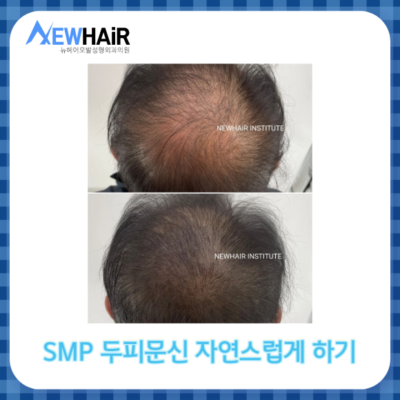 SMP 두피문신 자연스럽게 탈모커버 관련 이미지 6