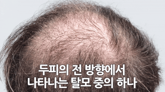 탈모치료방법, 비수술로 해결될까요? 관련 이미지 4