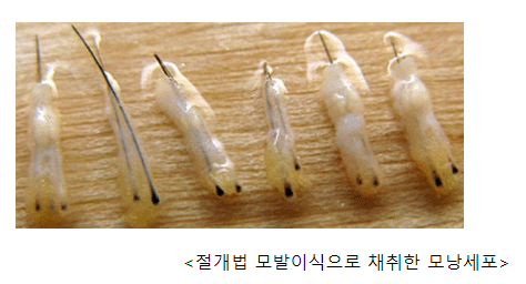 비절개 모발이식 vs 절개 모발이식 생착률 결과 차이 관련 이미지 5