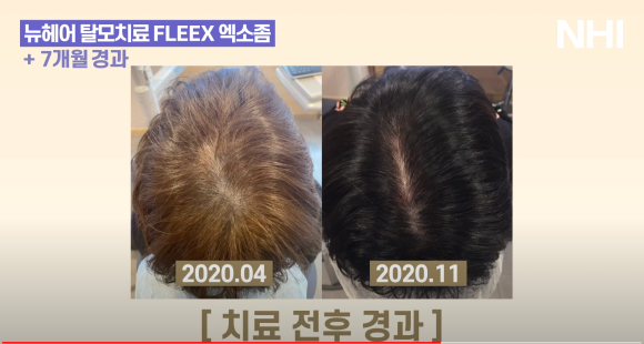 뉴헤어 탈모치료 모낭주사 7개월 전후 사진 관련 이미지 4