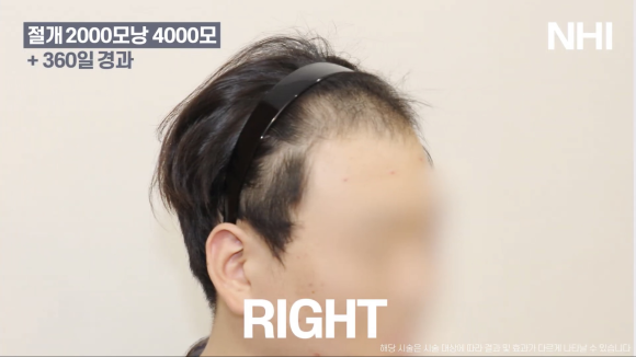 M자탈모(엠자탈모) 모발이식 1년 후 모습 공개 l 2000모낭(4000모) 관련 이미지 4