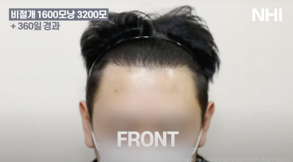 모발이식 비절개 1년 후기 전후사진 1600모낭 관련 이미지 2